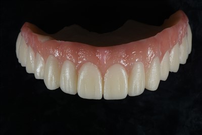 এক্রাইলিক রজন অস্থায়ী মুকুট